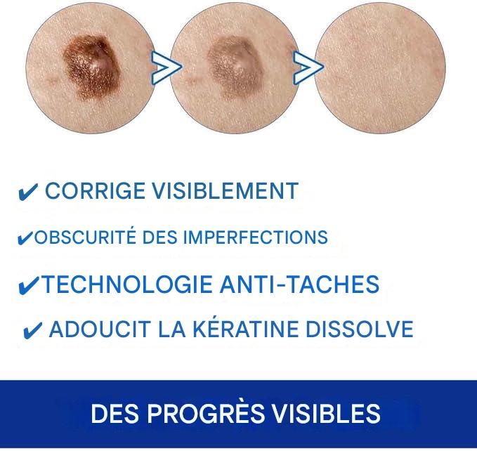 crème pour éliminer les verrues